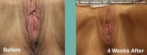 Labiaplasty