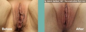 Labiaplasty