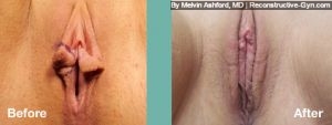 Labiaplasty