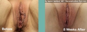 Labiaplasty