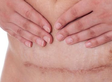 Post Cesarean Scar "Apron" Repair