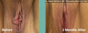 Labiaplasty