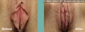 Labiaplasty and Clitoroplasty