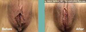 Labiaplasty