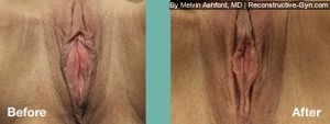 Labiaplasty