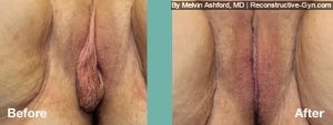 Labiaplasty