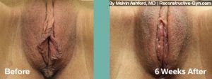 Labiaplasty and Clitoroplasty