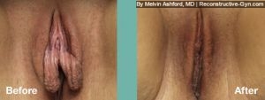 Labiaplasty and Clitoroplasty