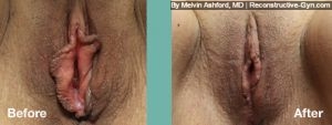 Labiaplasty