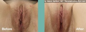 Labiaplasty