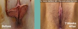 Labiaplasty