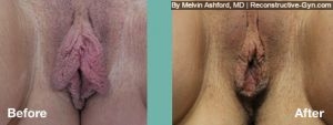 Labiaplasty