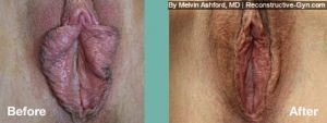 Labiaplasty