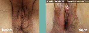 Fat Transfer