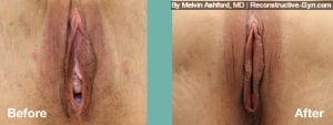 Labiaplasty