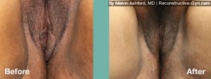 Labiaplasty