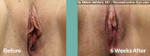 Labiaplasty
